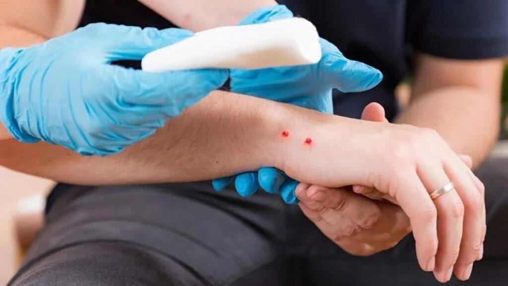 vibora-de-cascabel-garcia - CRONICAS REGIAS Medical professional in blue gloves applying a bandage to a small forearm wound.